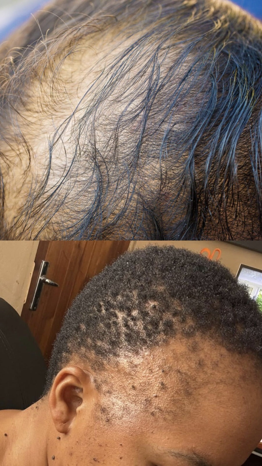 THINNING/BALDING HAIR AND HAIRLINE. HOW TO TACKLE IT